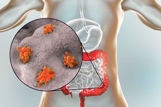 Types of parasites in the human body